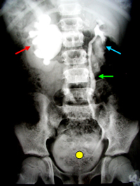 An Xray showing a blocked kidney with Hydronephrosis on one side (red arrow), and a normal kidney on the other side (blue arrow). Here the ureter is clearly seen (green arrow), going down to the urinary bladder (yellow dot)