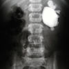 L PUJ obstruction with R absent function